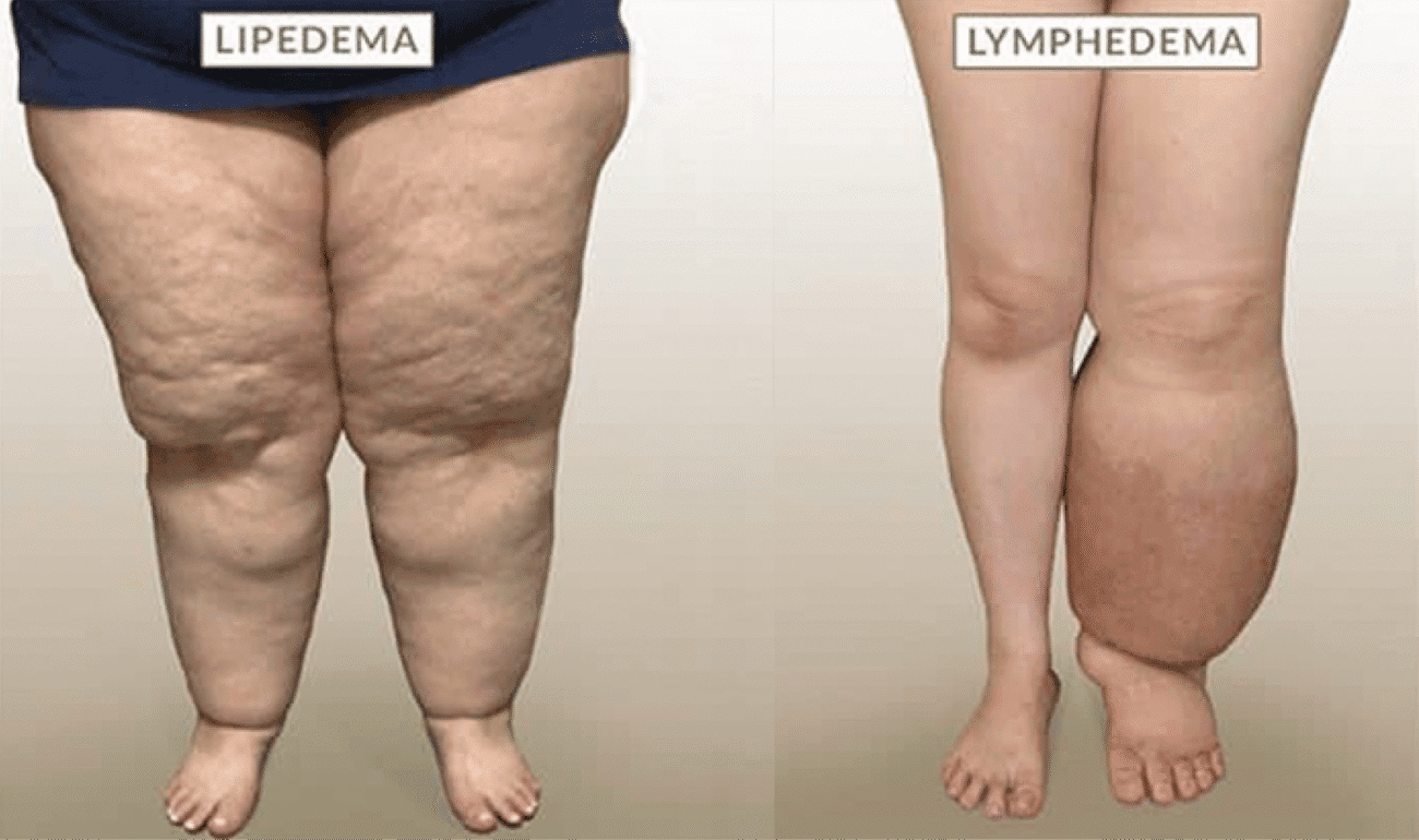 Lipedema vs Limfedema