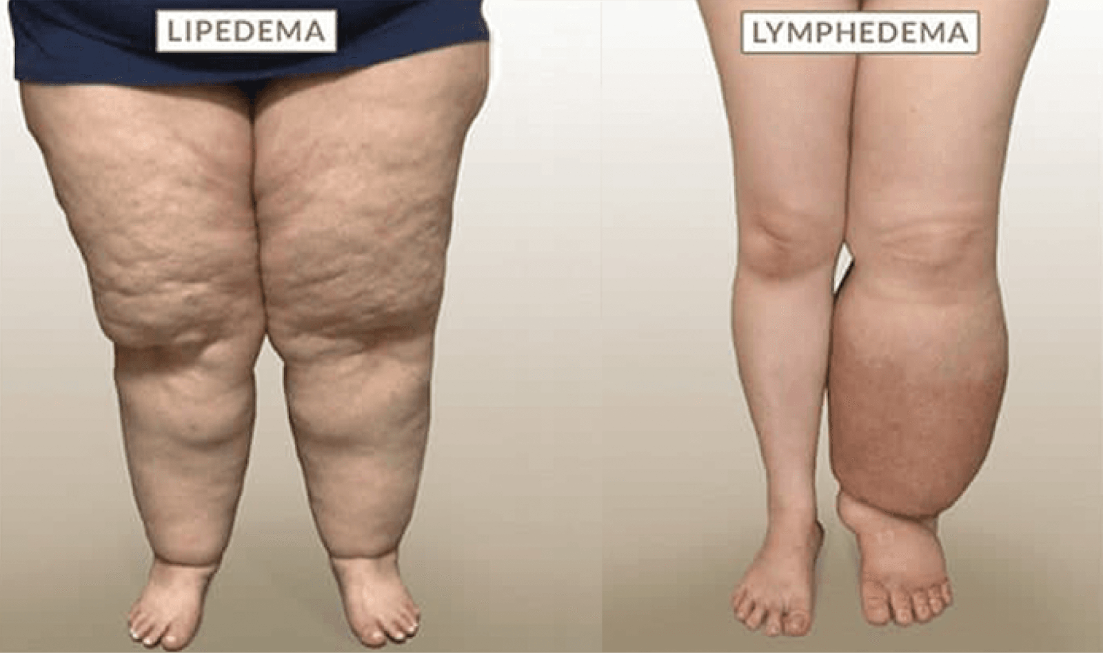 Lipedema vs Limfedema
