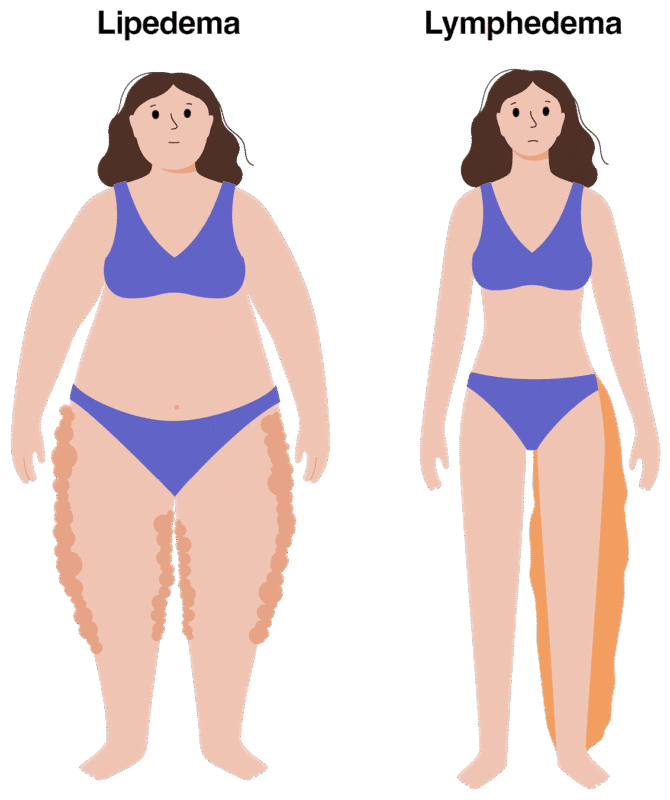 Perbedaan Lipedema dan Lymphedema