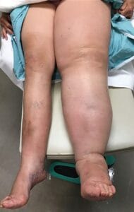 Lymphedema
